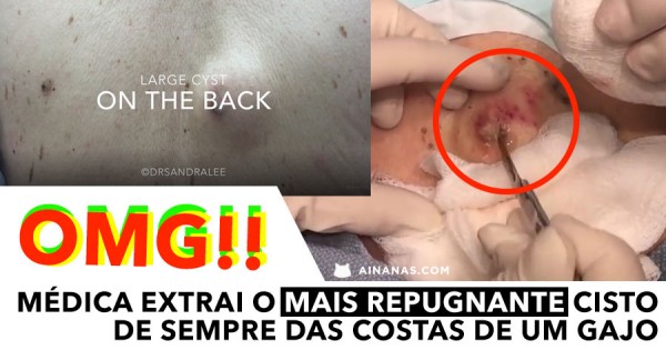 DASSEEE: Médica Extrai um Cisto GIGANTE das Costas de um Gajo