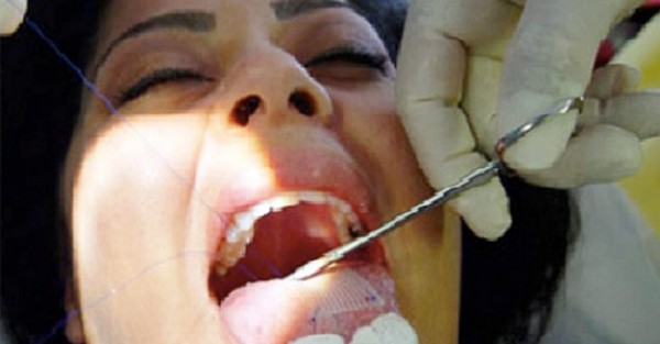Nova técnica para emagrecer: coser a língua