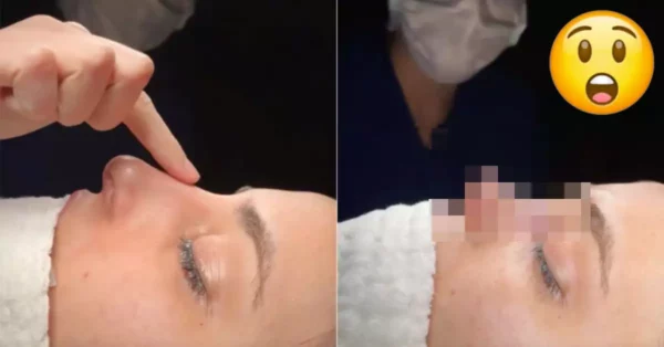 Rinoplastia Polémica: Cirurgiã Turca Divide Opiniões
